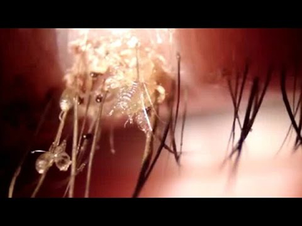 Doctors removed more than 20 lice that were living in this woman's EYE!