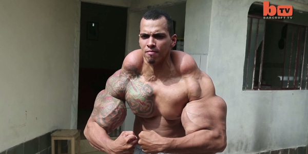 Real-Life Hulk May Have To Get His Arms AMPUTATED!