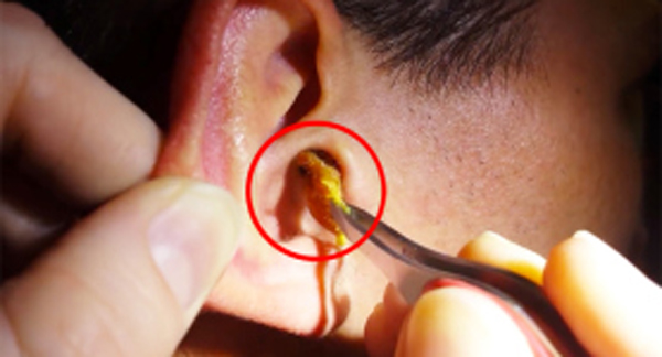 The Ear Wax Monster VIDEO Is The Grossest Thing You’ll See Today